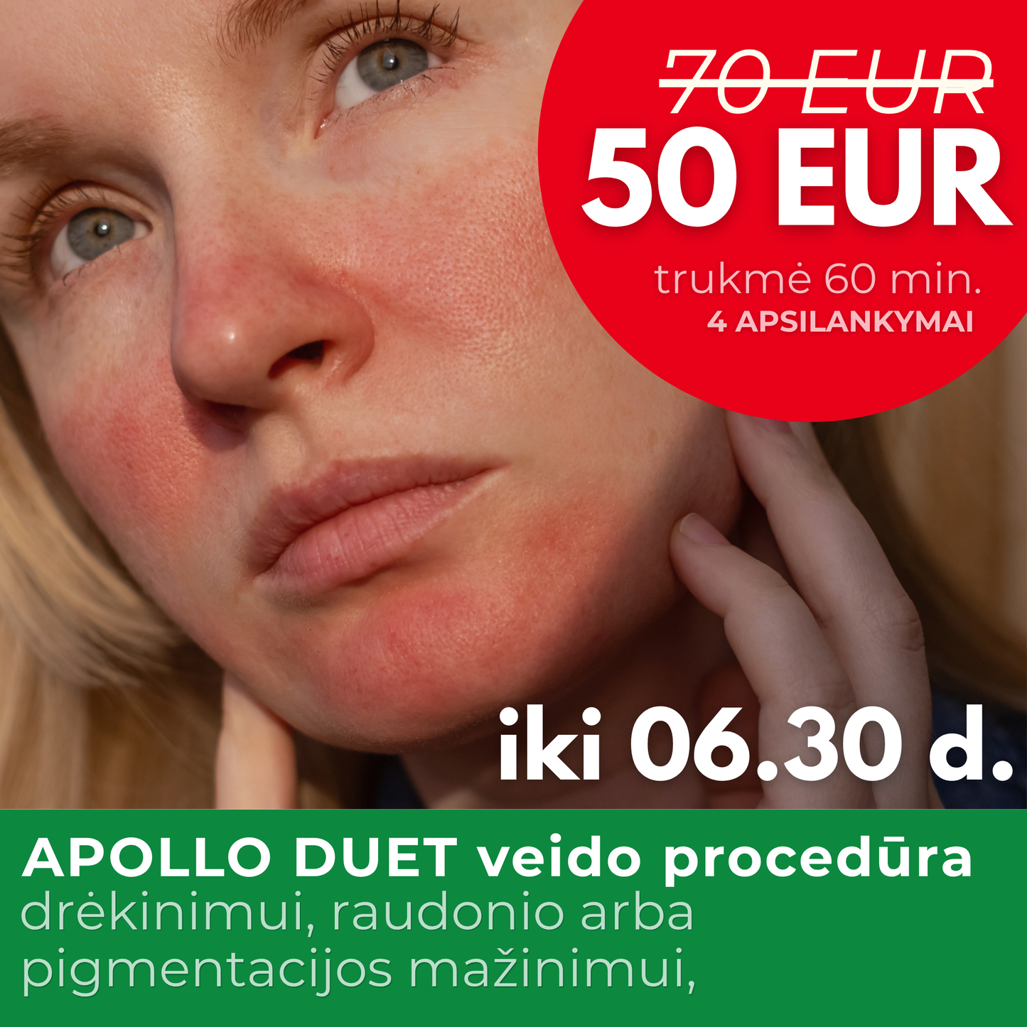 💧 Apollo Duet veido procedūra raudoniui, drėkinimui ir pigmentacijai